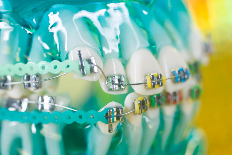 Jak dbać o aparat ortodontyczny: Praktyczne porady i wskazówki
